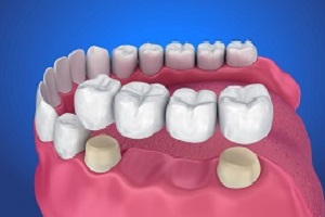 Braces & Aligners Image