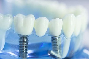 Dental Implants Image